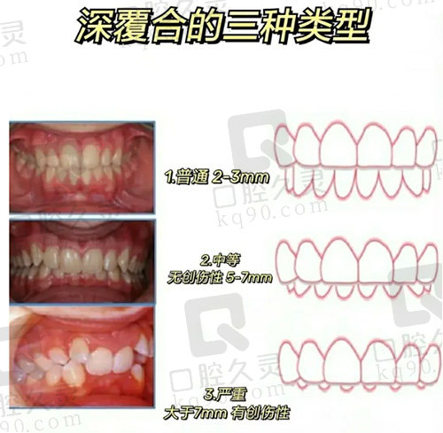 深覆合的种类