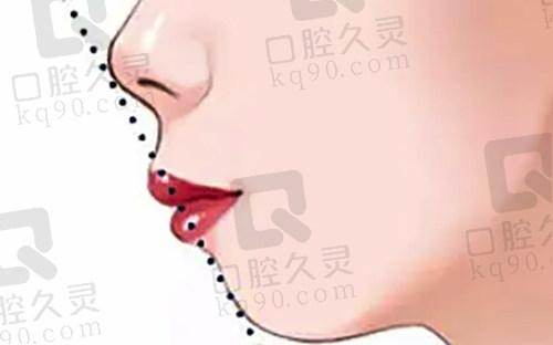 门牙外凸不建议矫正