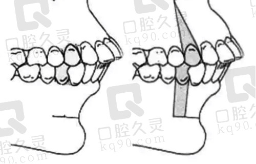 骨性前途和牙性前突对比