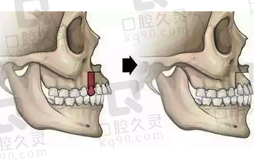 骨性前突通过正颌手术改善
