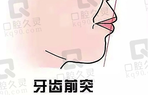 牙齿前突卡通示范图