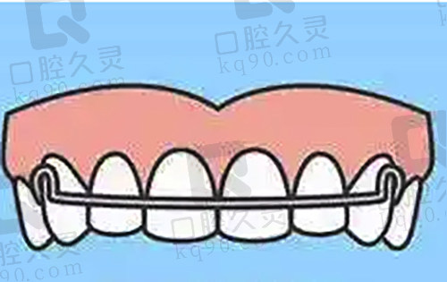 做完矫正及时佩戴保持器