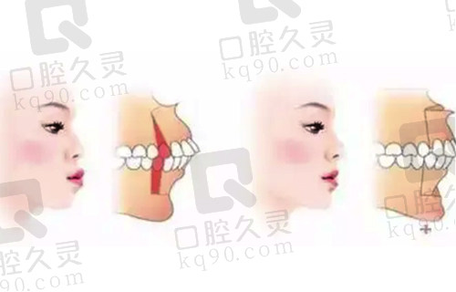 嘴凸整牙前后对比图