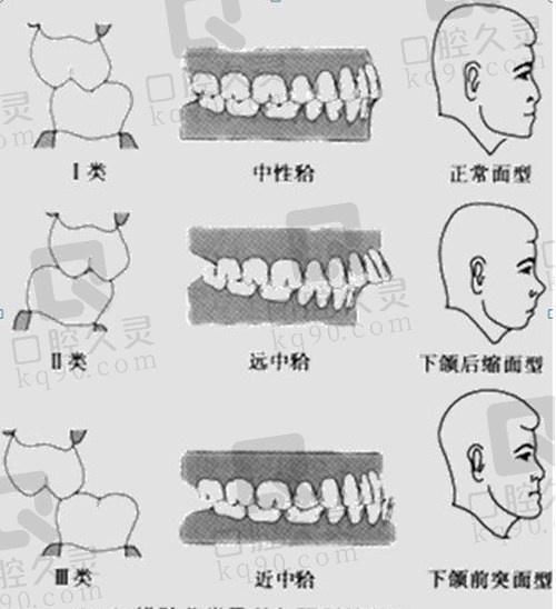 正畸错颌畸形的安氏分类