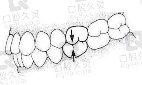 安氏Ⅰ类