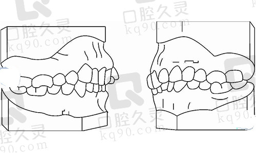 正畸错颌畸形