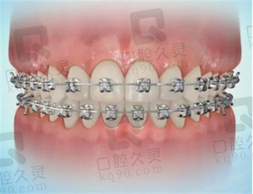 Ormco奥美科自锁托槽矫正的特点和优势2