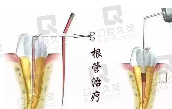 牙洞过大需配合根管治疗