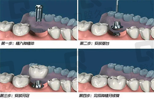 种植牙手术过程