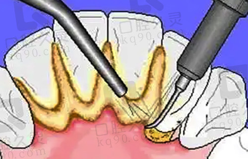 不要去随便做牙龈下刮治