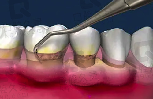 牙周炎治疗方式示范