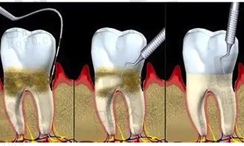 不同牙周炎程度治疗方式