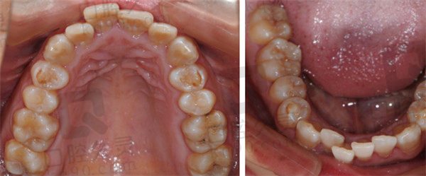 抚顺佳泽口腔牙齿不齐矫正前