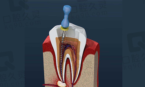 传统根管治疗