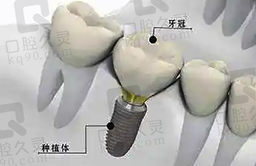 种植牙结构示范图
