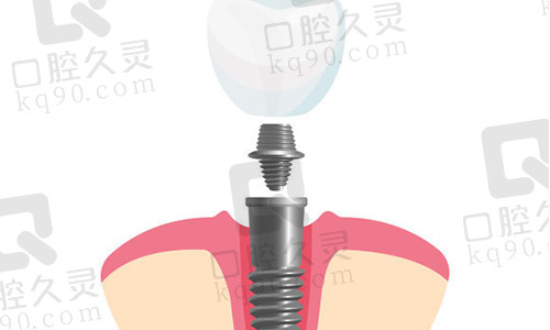 种植牙实物图