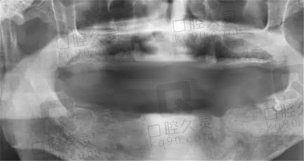 天津中诺口腔活动假牙术前CT照
