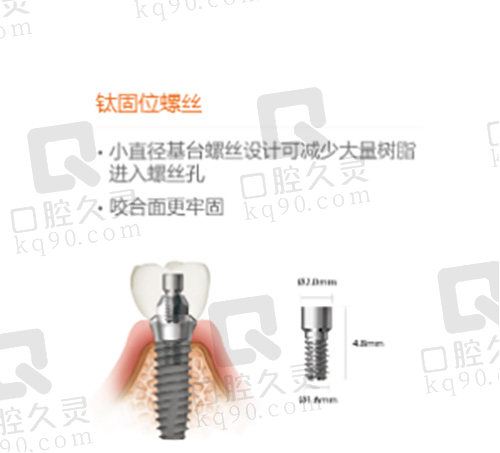 韩国登腾二代种植牙SuperLine II螺丝