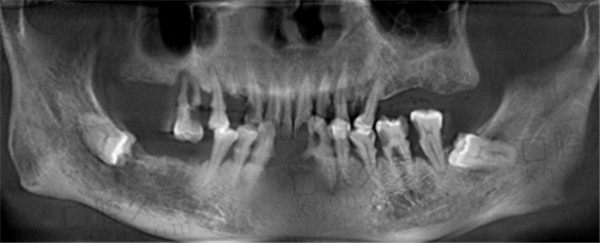 苏州美奥口腔植牙口腔CT照