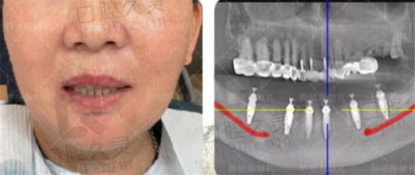 福州维乐口腔陈献礼种植牙术后