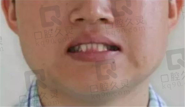 成都唐牙科地包天矫正前