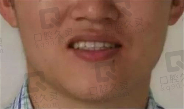 成都唐牙科地包天矫正后5年