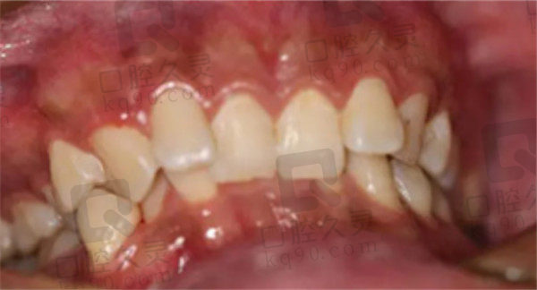 衡阳植美口腔牙齿矫正术前牙齿