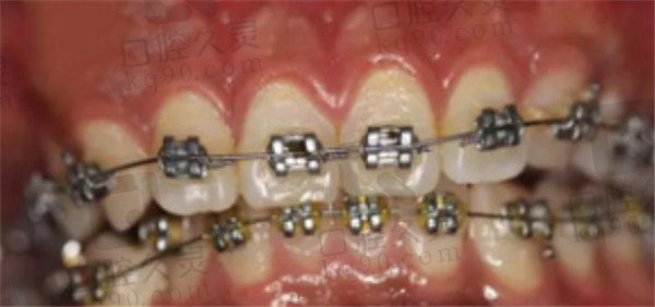 衡阳植美口腔牙齿矫正2个月后