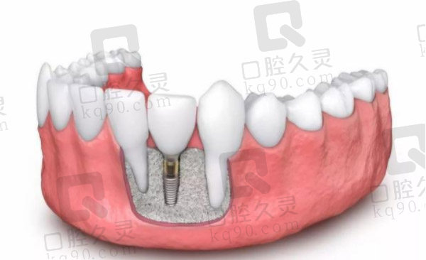 种植牙植骨