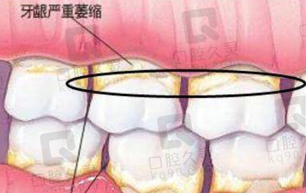 牙龈萎缩