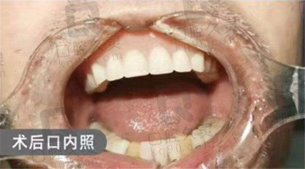 东莞莞口活动义齿术后