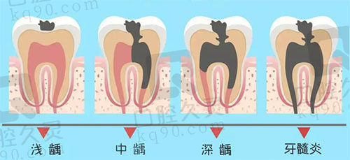 龋齿的发展阶段