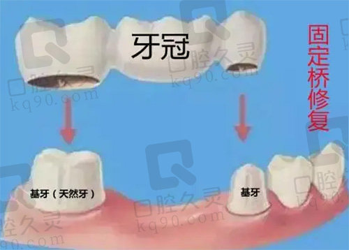 镶牙固定桥修复