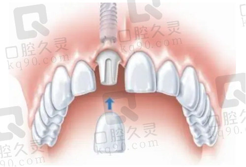 种植牙修复