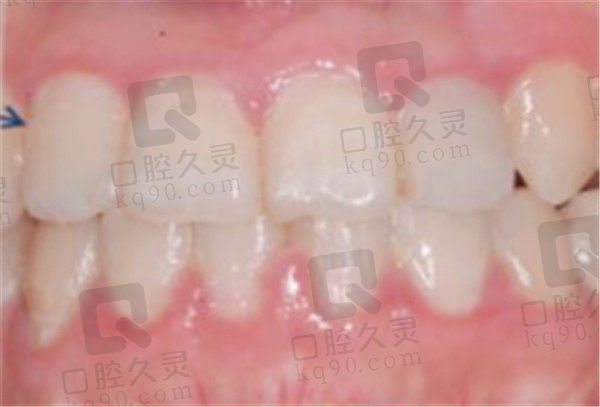 北京科尔口腔地包天矫正术后