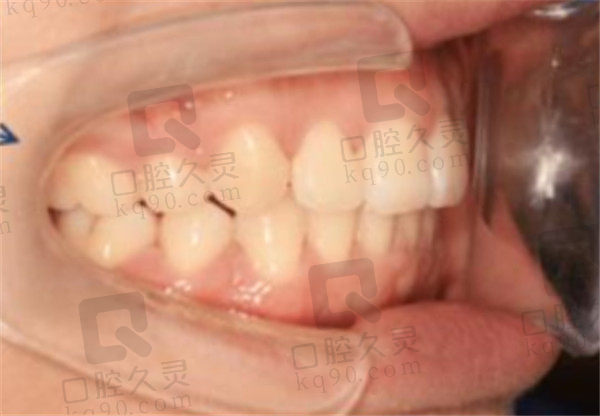 北京科尔口腔龅牙矫正术后