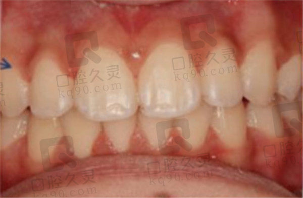 北京科尔口腔深覆合矫正术后