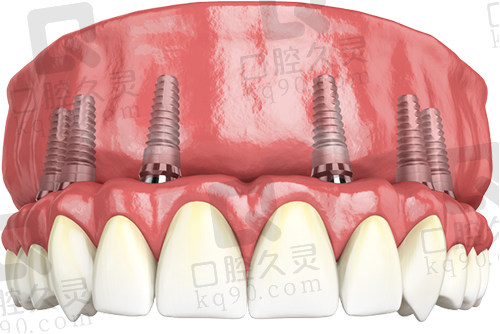 种植牙全固定式