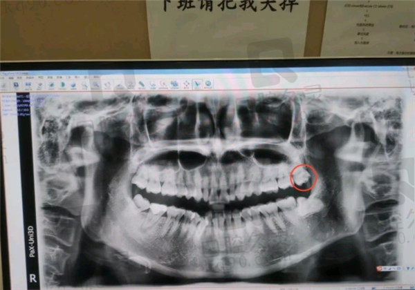 廊坊三河紫丁香口腔拔牙口腔CT照