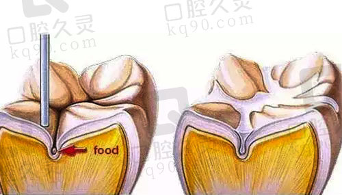 儿童窝沟封闭前后对比