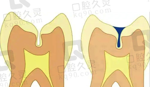 窝沟封闭完成示范图