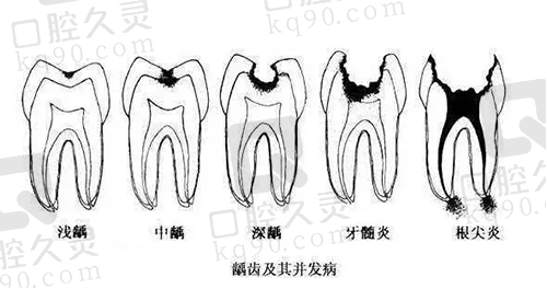 龋病的发展过程