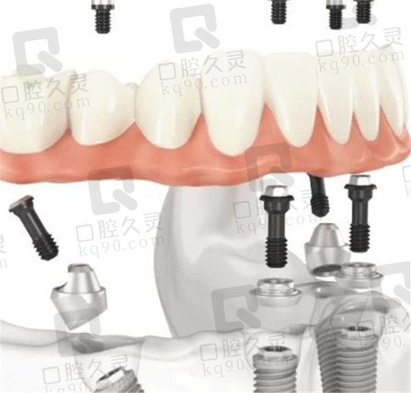 All-ON-4种植牙优势