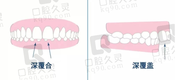 深覆盖和深覆合