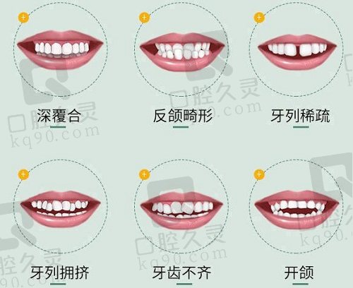 成都圣贝口腔国产隐形矫正适应范围