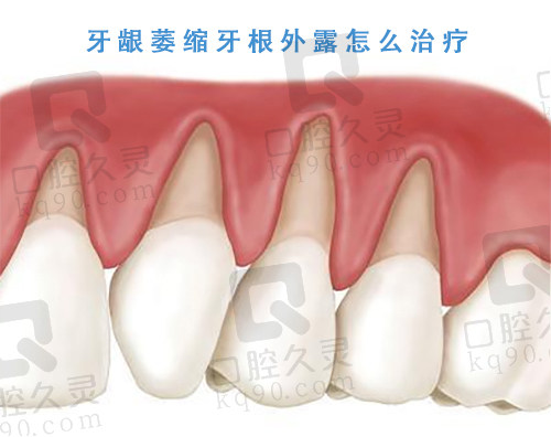 牙龈萎缩牙根外露怎么治疗