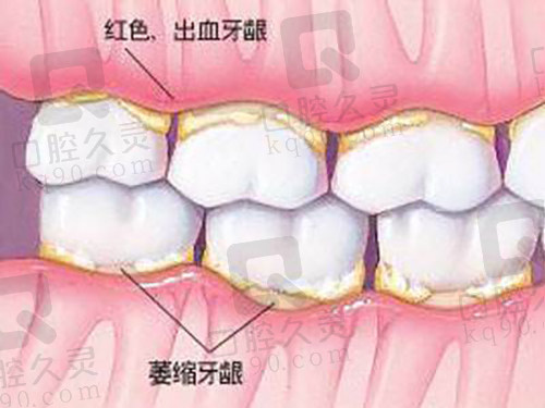 牙龈萎缩外露的原因