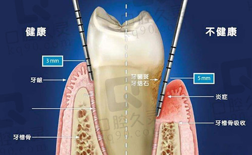 健康牙龈和萎缩牙龈对比图