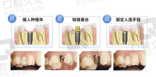 种植牙过程