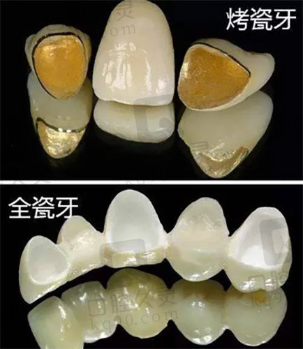 烤瓷牙和全瓷牙